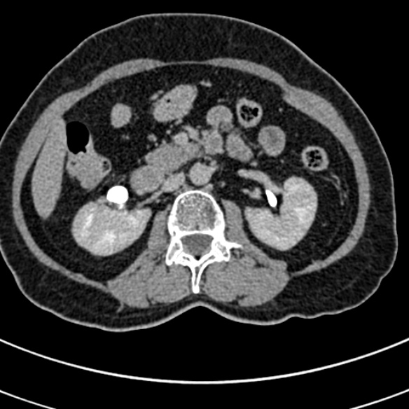 File:Normal CT split bolus study of the renal tract (Radiopaedia 48631-53634 Axial split bolus 82).jpg