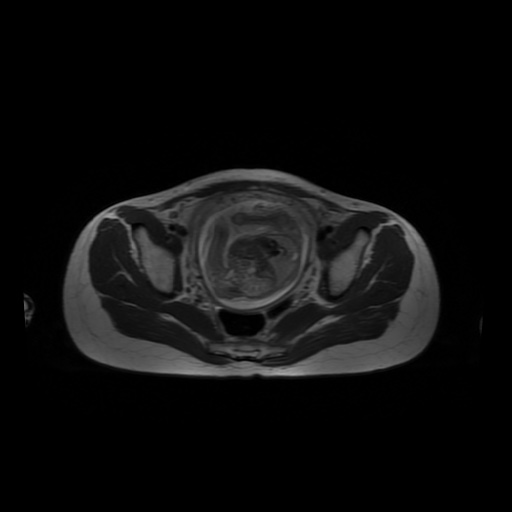 File:Normal MRI abdomen in pregnancy (Radiopaedia 88001-104541 Axial T2 60).jpg