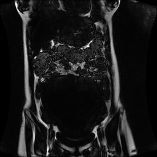 Normal MRI abdomen in pregnancy (Radiopaedia 88001-104541 N 49).jpg