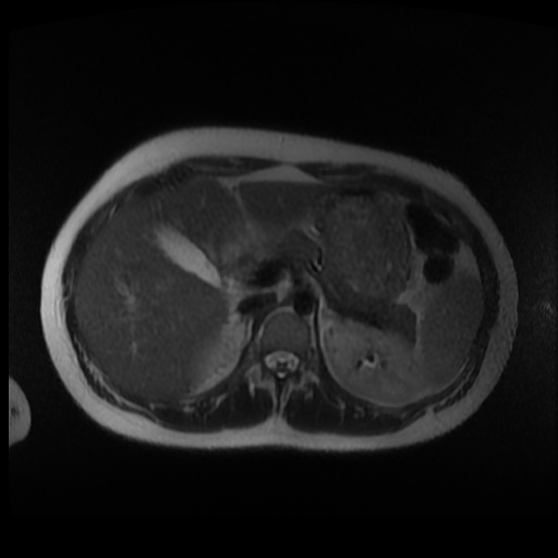 Normal MRI abdomen in pregnancy (Radiopaedia 88003-104546 Axial T2 4).jpg