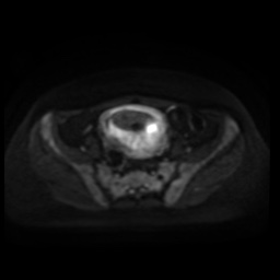 Normal MRI abdomen in pregnancy (Radiopaedia 88005-104548 Axial DWI 61).jpg