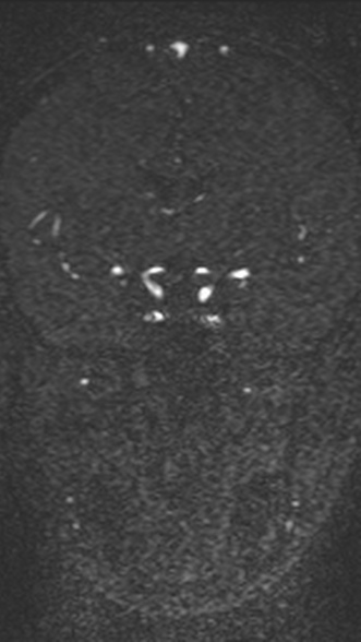 Normal MRI brain with MRV- teenager (Radiopaedia 49425-54553 Coronal MRV 113).jpg