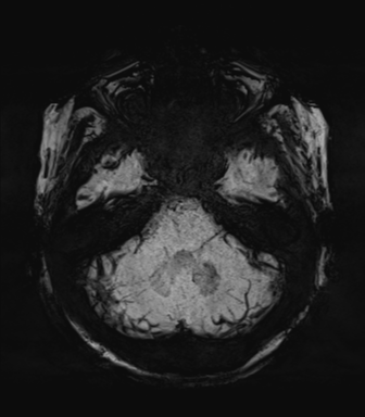 Normal MRI internal auditory canal (Radiopaedia 41613-44525 Axial SWI MIP 19).png