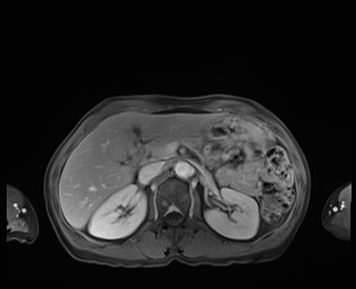 Normal adrenal glands MRI (Radiopaedia 82017-96004 M 33).jpg