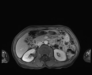 Normal adrenal glands MRI (Radiopaedia 82017-96004 M 40).jpg