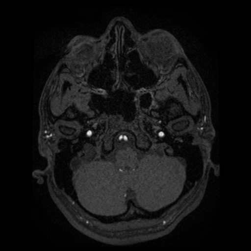 Normal brain MRA (Radiopaedia 41046-43793 Axial MRA 102).png