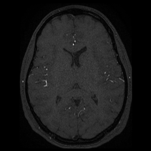 Normal brain MRA (Radiopaedia 41046-43793 Axial MRA 15).png
