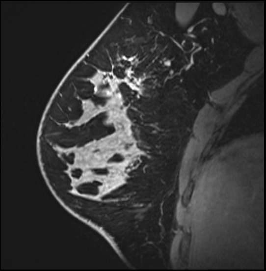 Normal breast MRI - dense breasts (Radiopaedia 80454-93850 I 64).jpg
