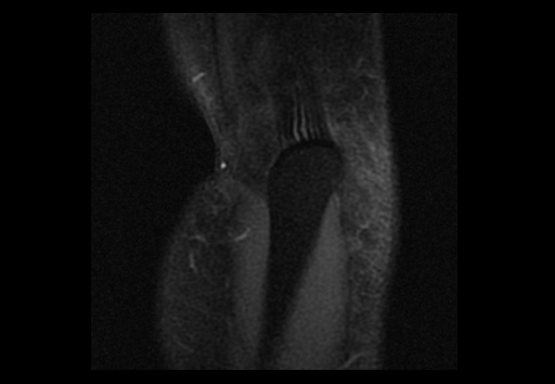File:Normal elbow arthrograms (Radiopaedia 75550-86805 Coronal T1 fat sat 1).jpg