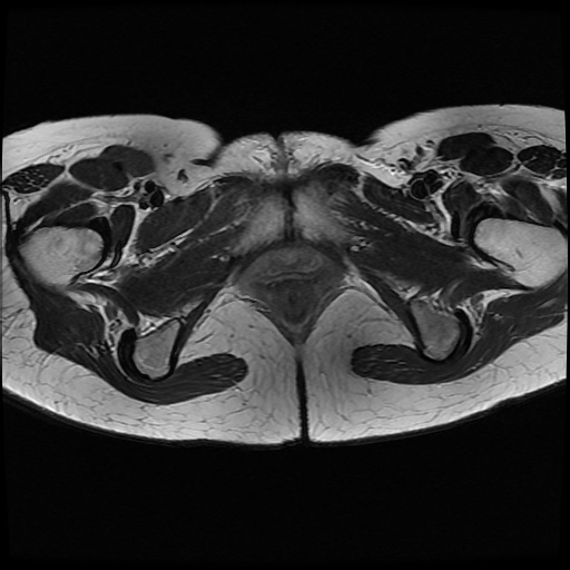 File:Normal female pelvis MRI (retroverted uterus) (Radiopaedia 61832-69933 Axial T2 27).jpg