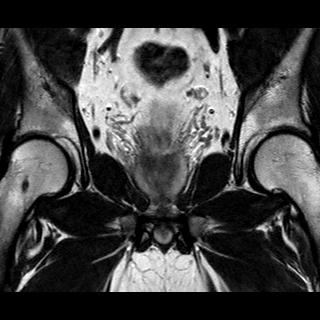 File:Normal prostate (MRI) (Radiopaedia 29986-30535 Coronal T2 10).jpg