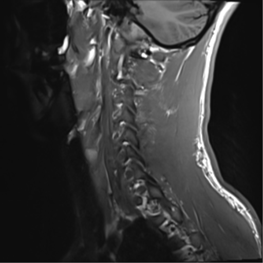 File:Normal trauma cervical spine (Radiopaedia 41017-43762 Sagittal T1 15).png