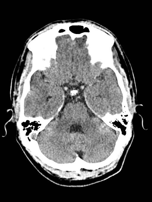 Normal trauma protocol brain and C-spine CT (Radiopaedia 83302-97709 Axial non-contrast 51).jpg