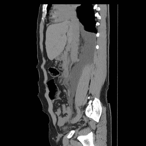 File:Obstructed kidney with perinephric urinoma (Radiopaedia 26889-27066 B 22).jpg