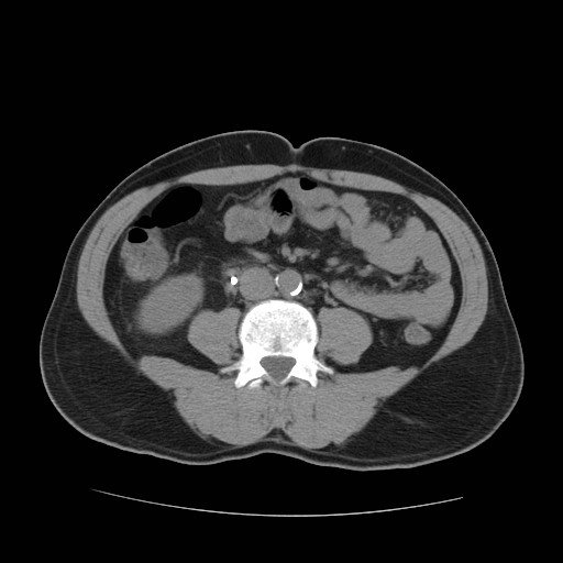 File:Obstructed kidney with perinephric urinoma (Radiopaedia 26889-27067 Axial non-contrast 22).jpg