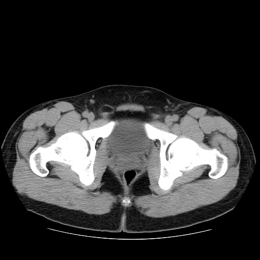File:Obstructing ureteric calculus (Radiopaedia 18615-18514 Axial non-contrast 55).jpg