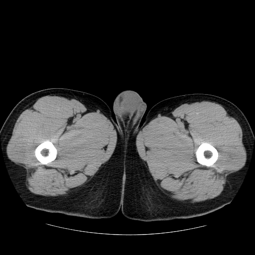 File:Obstructing ureteric calculus (Radiopaedia 18615-18514 Axial non-contrast 66).jpg
