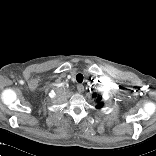 File:Obstructive superior vena cava tumor thrombus (Radiopaedia 28046-28306 A 4).jpg