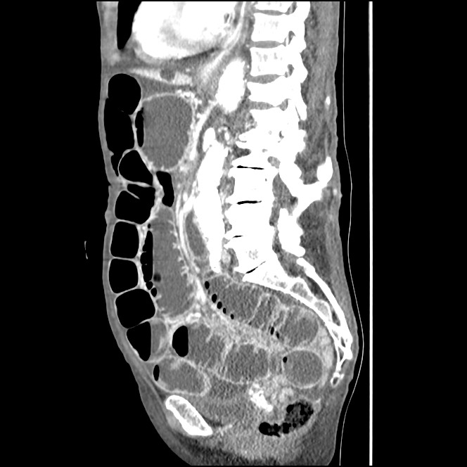 Obturator hernia causing small bowel obstruction (Radiopaedia 65522-74612 C 48).jpg