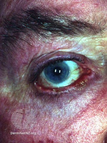 File:Ocular pemphigus vulgaris (DermNet NZ immune-pgus6).jpg