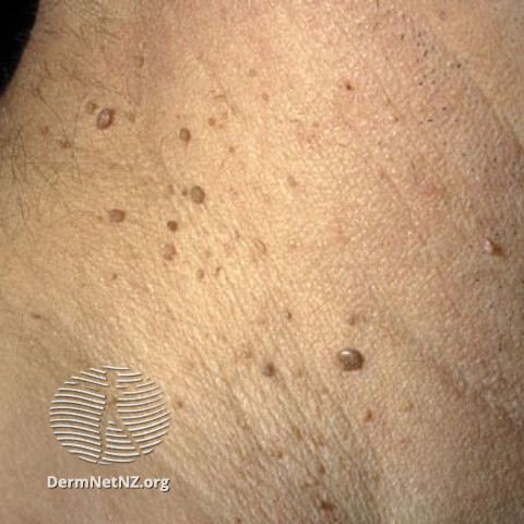 File:Seborrhoeic keratosis (DermNet NZ lesions-s-sebk-skintag).jpg