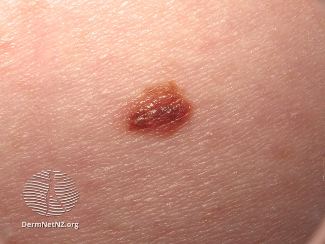 File:Small melanoma (DermNet NZ melanoma-abcds-21).jpg