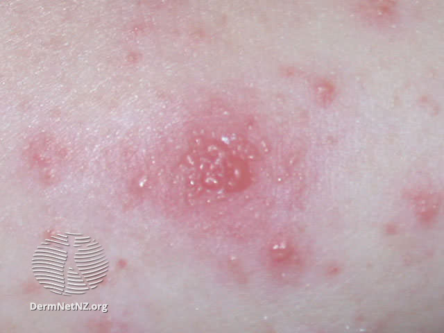 File:Vesicles due to eczema (DermNet NZ vesicles).jpg