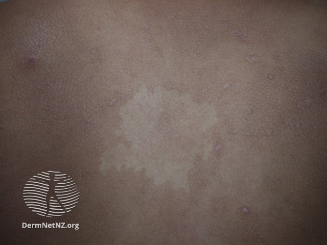 File:(DermNet NZ lesions-naevus-depigmentosus-1).jpg
