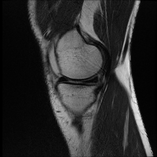 File:ACL acute full thickness tear - deep lateral femoral sulcus sign (Radiopaedia 38594-40740 Sagittal T2 4).jpg