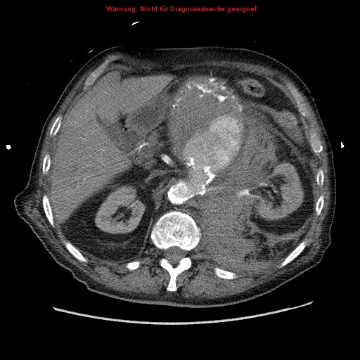 Abdominal aortic aneurysm- extremely large, ruptured (Radiopaedia 19882-19921 Axial C+ arterial phase 21).jpg