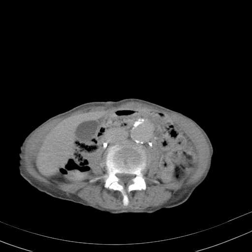 File:Abdominal aortic aneurysm (Radiopaedia 20827-20742 Axial C+ delayed 17).jpg