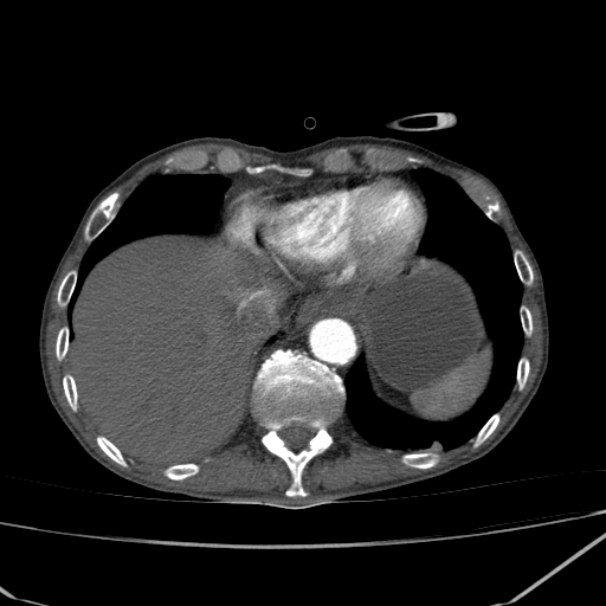 Abdominal aortic aneurysm (Radiopaedia 23703-23856 Axial C+ arterial phase 1).jpg