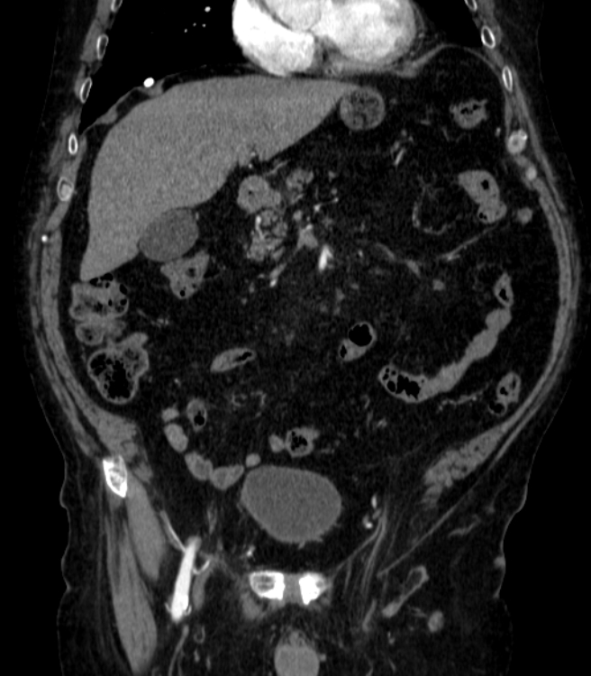 Abdominal aortic aneurysm (Radiopaedia 25855-26001 Coronal C+ arterial phase 12).jpg