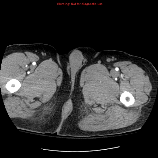 Abdominal aortic aneurysm (Radiopaedia 8190-9038 Axial C+ arterial phase 97).jpg
