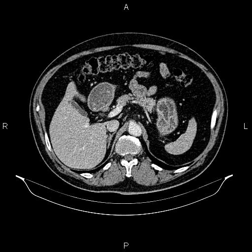 Abdominal aortic aneurysm (Radiopaedia 83094-97462 Axial renal cortical phase 81).jpg