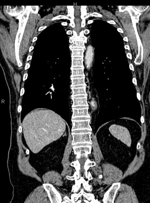 Abdominal aortic aneurysm (Radiopaedia 83094-97462 Coronal renal cortical phase 68).jpg