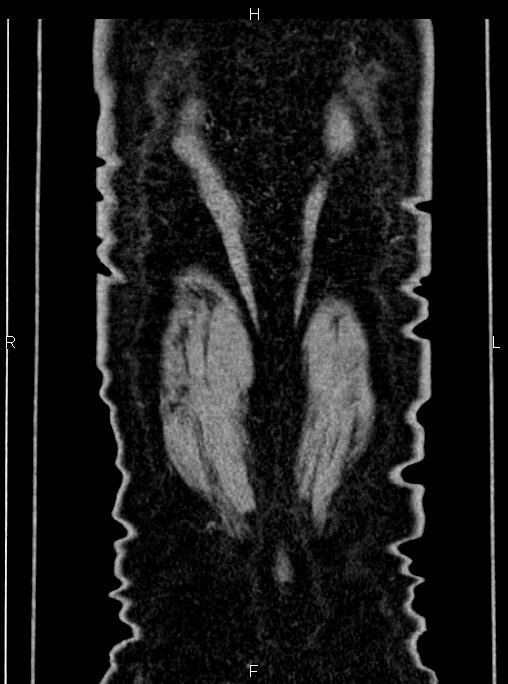 Abdominal aortic aneurysm (Radiopaedia 83094-97462 Coronal renal cortical phase 91).jpg