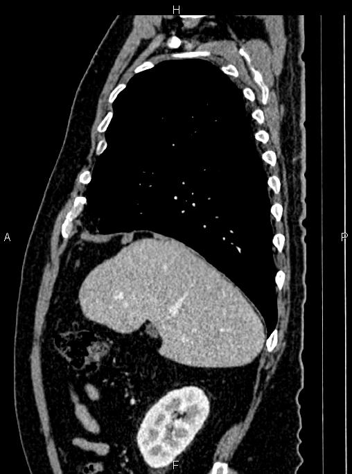 Abdominal aortic aneurysm (Radiopaedia 83094-97462 Sagittal renal cortical phase 35).jpg