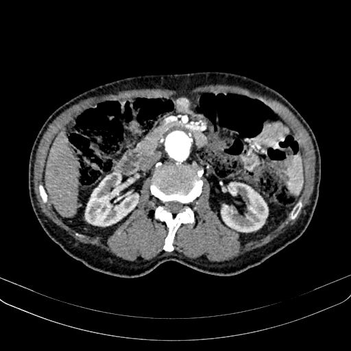 Abdominal aortic aneurysm (Radiopaedia 83581-98689 Axial C+ arterial phase 53).jpg