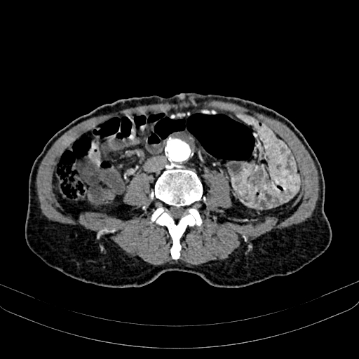 Abdominal aortic aneurysm (Radiopaedia 83581-98689 Axial C+ arterial phase 70).jpg