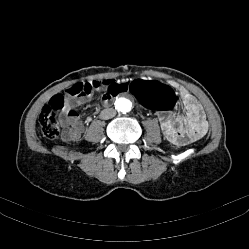 Abdominal aortic aneurysm (Radiopaedia 83581-98689 Axial C+ arterial phase 71).jpg