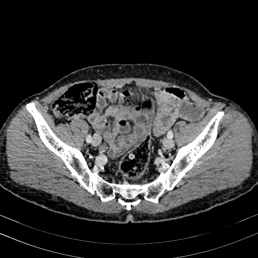 Abdominal aortic aneurysm (Radiopaedia 83581-98689 Axial C+ portal venous phase 91).jpg