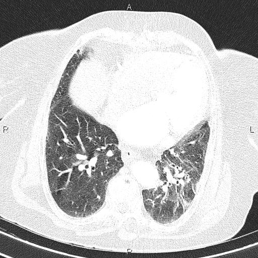 Abdominal aortic aneurysm (Radiopaedia 85063-100606 Axial lung window 44).jpg