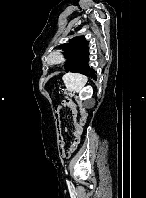 Abdominal aortic aneurysm (Radiopaedia 85063-100606 Sagittal C+ arterial phase 68).jpg
