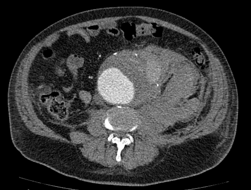 Abdominal aortic aneurysm rupture (Radiopaedia 54179-60362 Axial C+ arterial phase 37).jpg