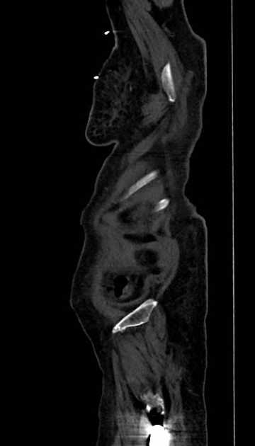 Abdominal aortic aneurysm with thrombus fissuration (Radiopaedia 73192-83919 Sagittal C+ arterial phase 136).jpg