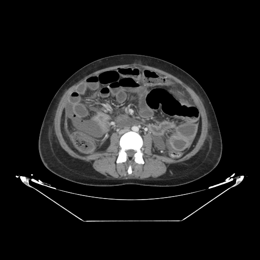 Abdominal gossypiboma- surgical towel (Radiopaedia 57288-64226 Axial C+ portal venous phase 38).jpg