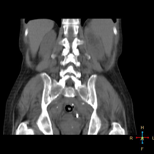 File:Abdominal lymphoma (Radiopaedia 23085-23115 Coronal non-contrast 3).jpg