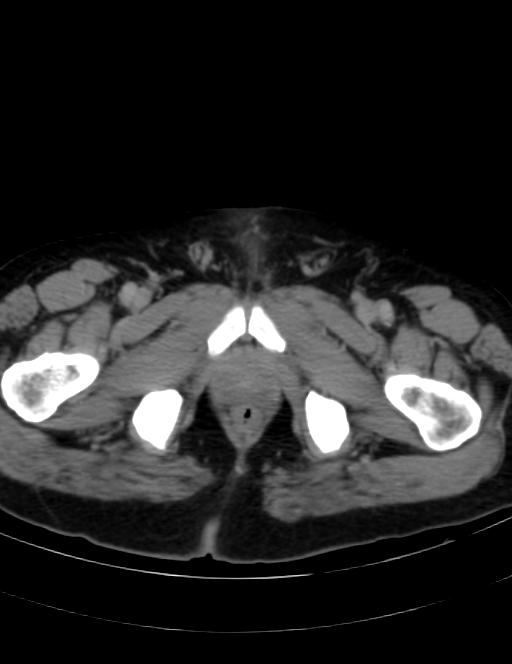 Abdominal lymphoma - with sandwich sign (Radiopaedia 53486-59492 Axial C+ portal venous phase 52).jpg