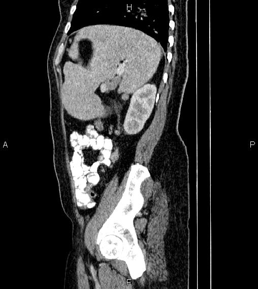 Abdominal lymphoma with sandwich sign (Radiopaedia 84378-99704 Sagittal C+ portal venous phase 72).jpg